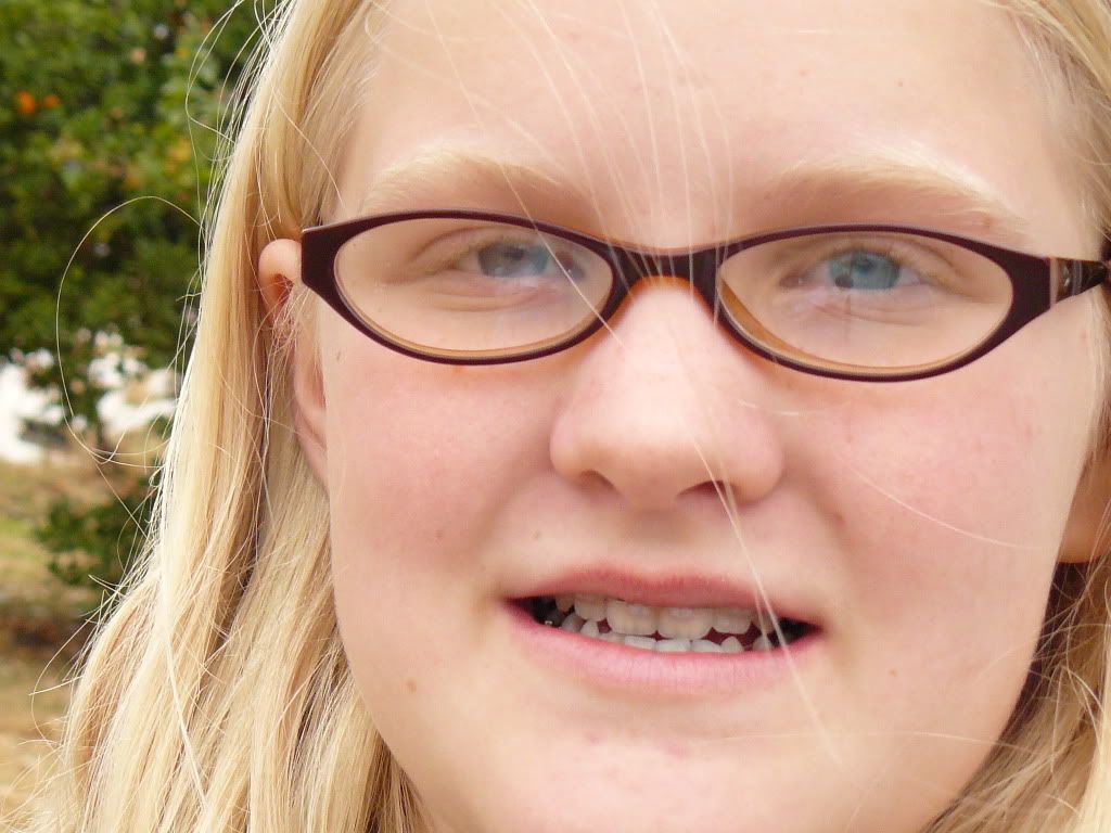 Before And After Braces Before And After Braces Just On Top